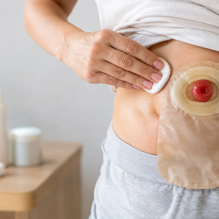 Cuidados com a pele periestomal na ostomia